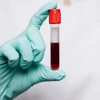 Esami ematochimici prelievo venoso analisi del sangue a treviso zero branco