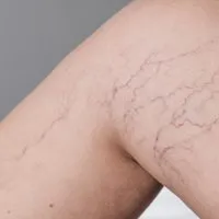 Scleroterapia vene varicose capillari gambe a Zero Branco Treviso