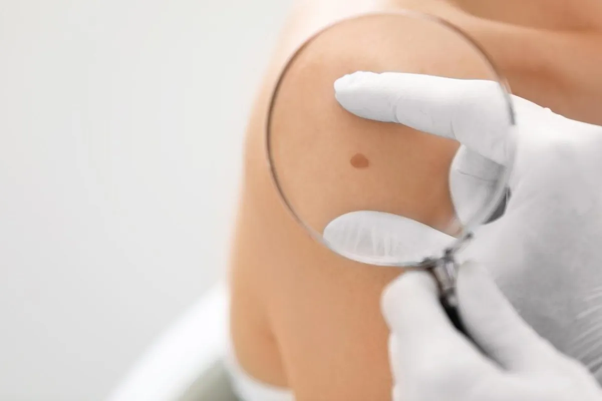 Asportazione nevi cisti lipomi Zero Medical Center Treviso